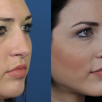 An Overview On Rhinoplasty Recovery – How Long Does It Take to Recover From a Nose Job?